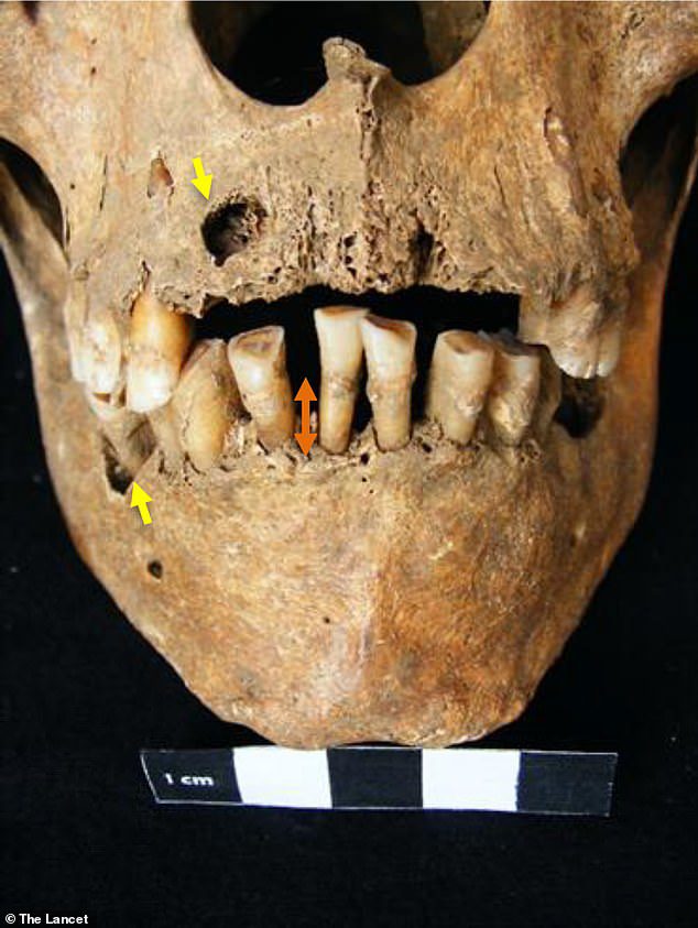 Aunque los arqueólogos no sabían que los restos estaban plagados de enfermedades, el cráneo presenta marcas como dientes más grandes que el promedio y una infección grave de las encías que dañó los tejidos blandos de la boca antes de morir.